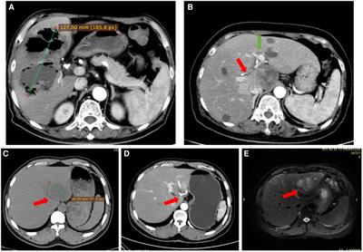 Clinical characteristics and management of 106 patients with pyogenic liver abscess in a traditional Chinese hospital